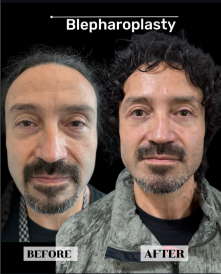 Upper blepharoplasty before-and-after, patient case 2