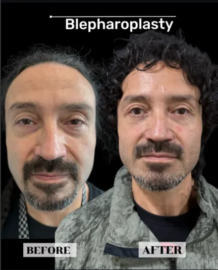Eyelid surgery before and after, patient 1 - Allure RT MX