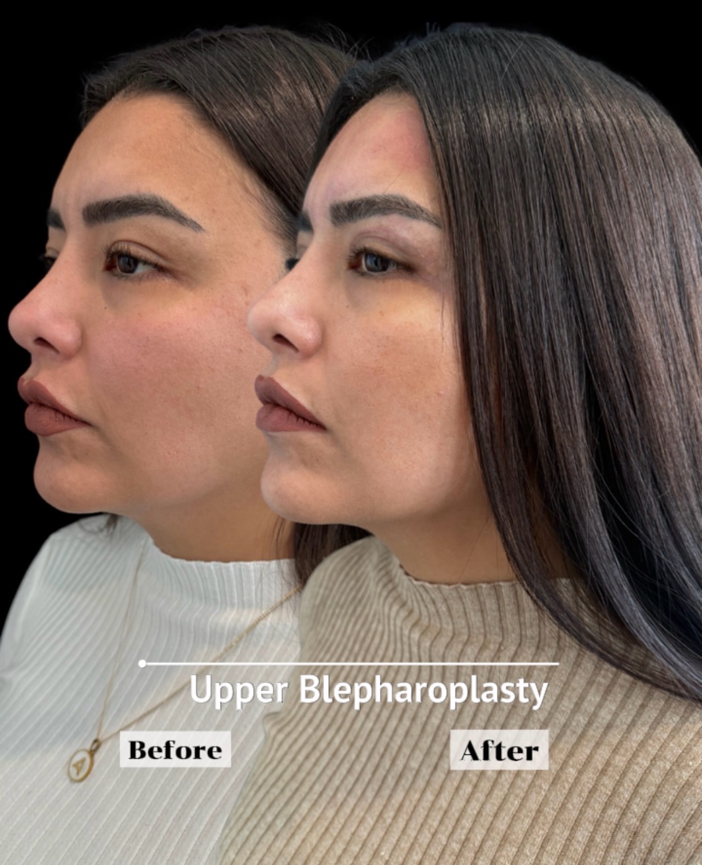 Eyelid surgery before and after, patient 2 - Allure RT MX