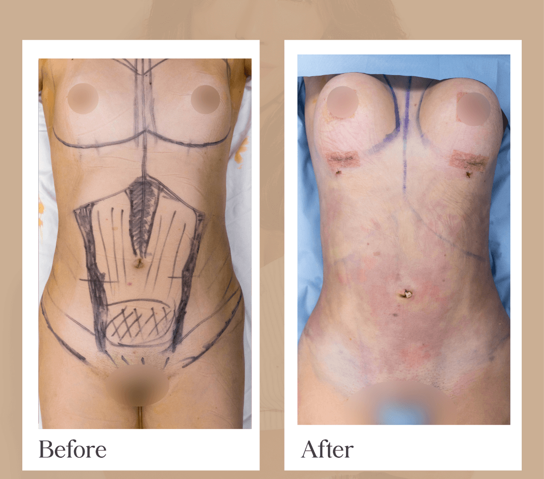 Mommy Makeover operative result, patient 1 - Allure RT MX
