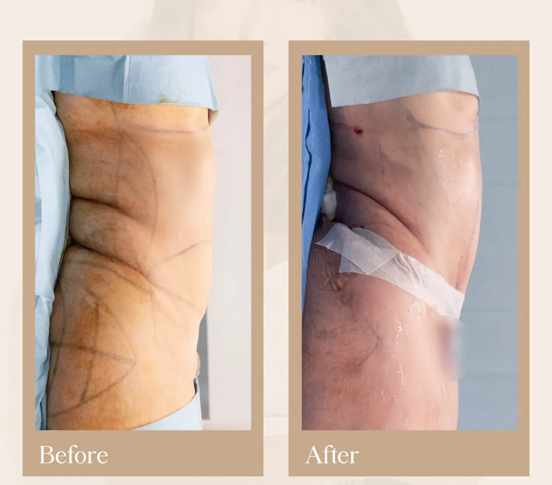 Tummy tuck operative result, patient 10 - Allure RT MX