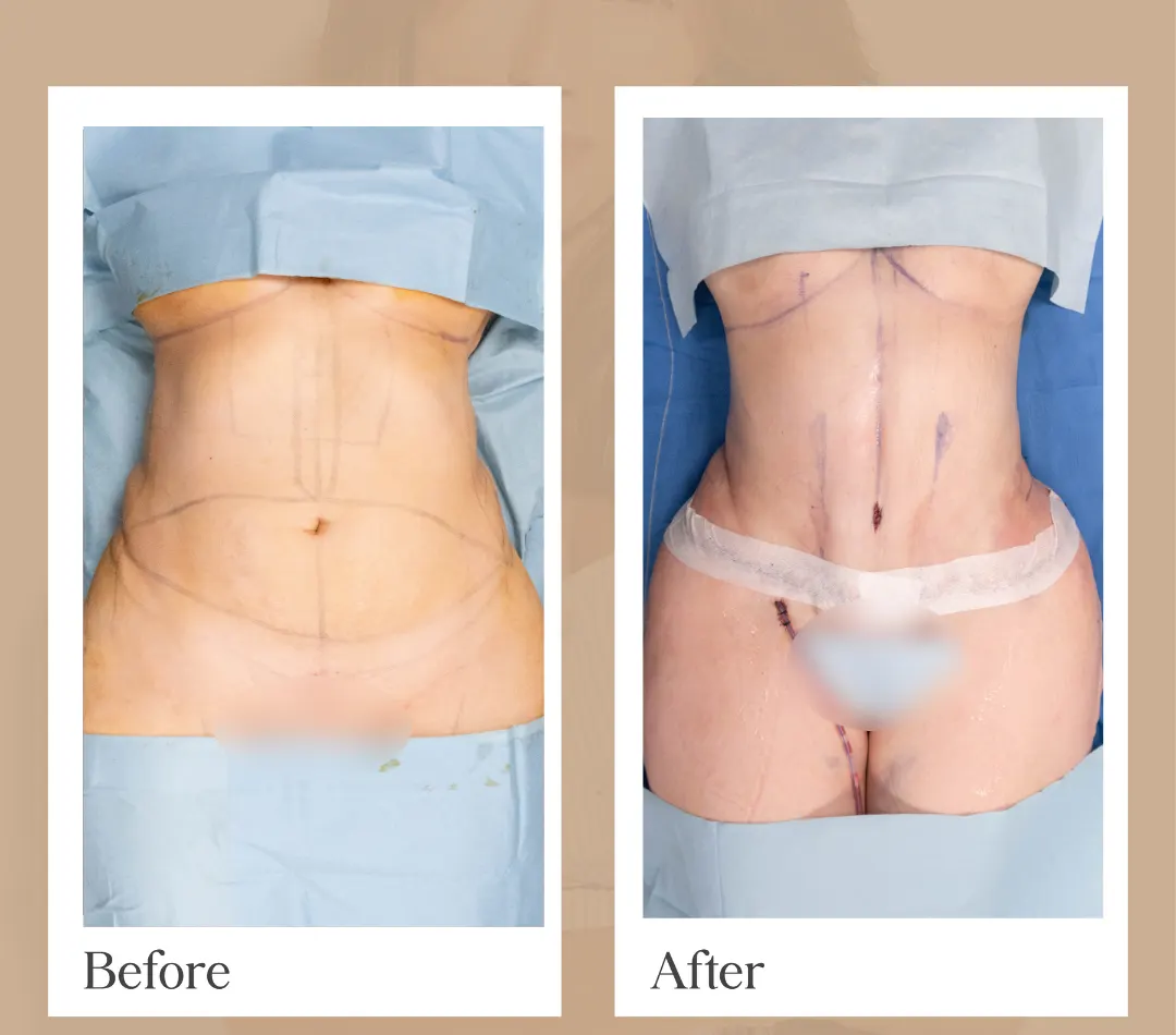 Body contouring operative result, patient 11 - Allure RT MX