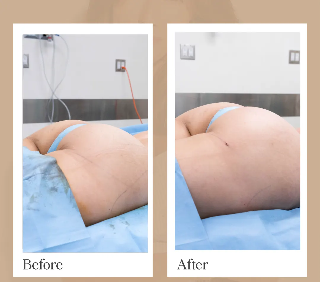 Body contouring operative result, patient 12 - Allure RT MX