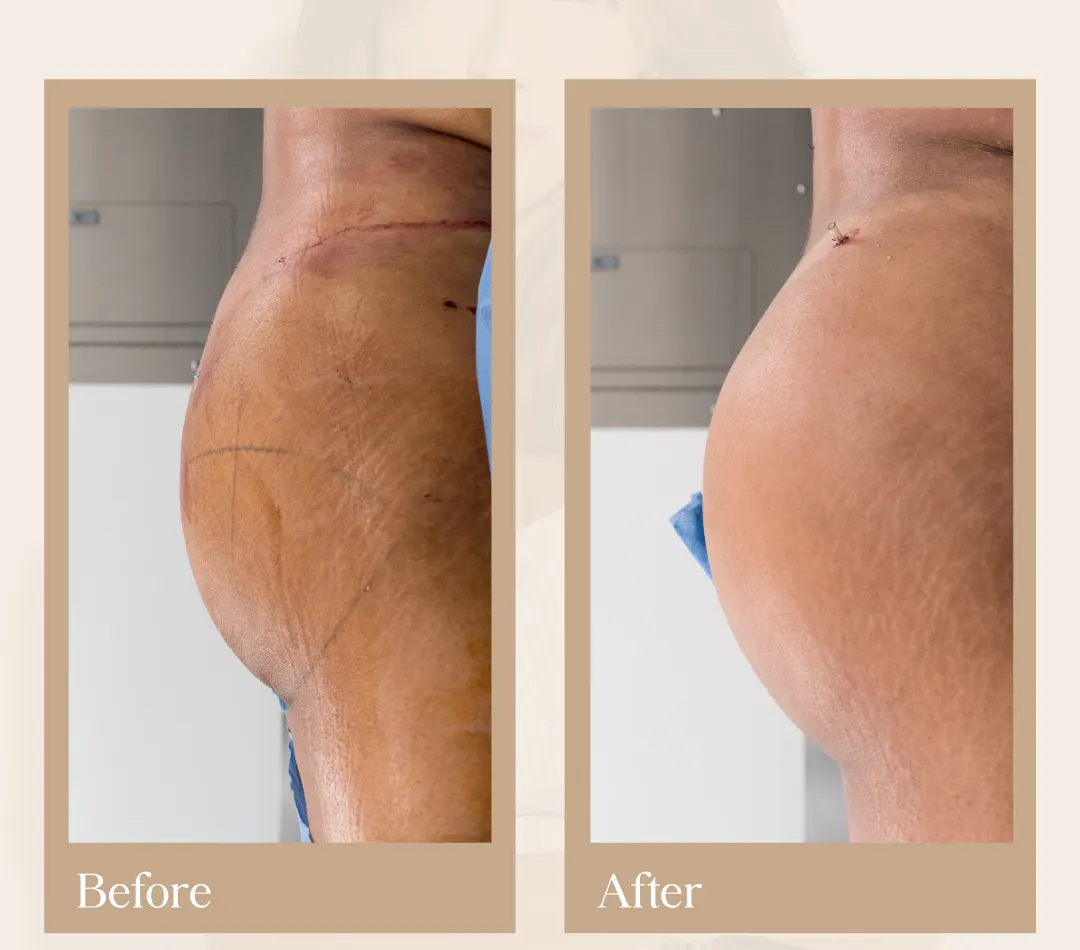 Tummy tuck operative result, patient 13 - Allure RT MX