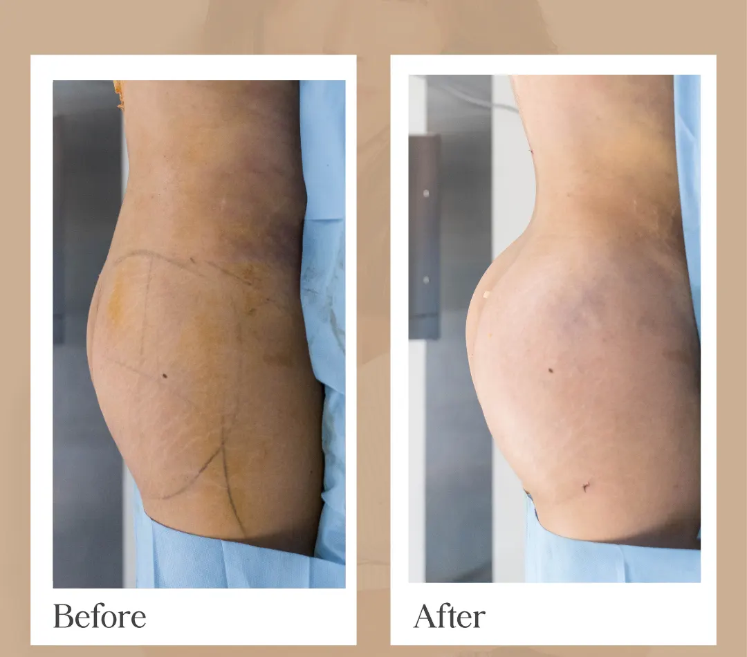 Mommy Makeover operative result, patient 18 - Allure RT MX