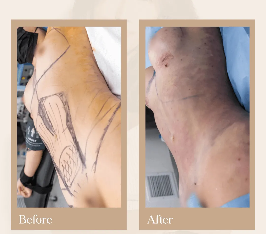 Body contouring operative result, patient 2 - Allure RT MX