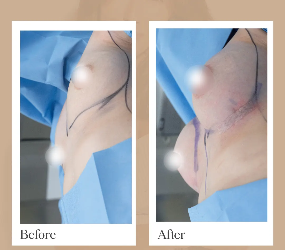 Body contouring operative result, patient 20 - Allure RT MX