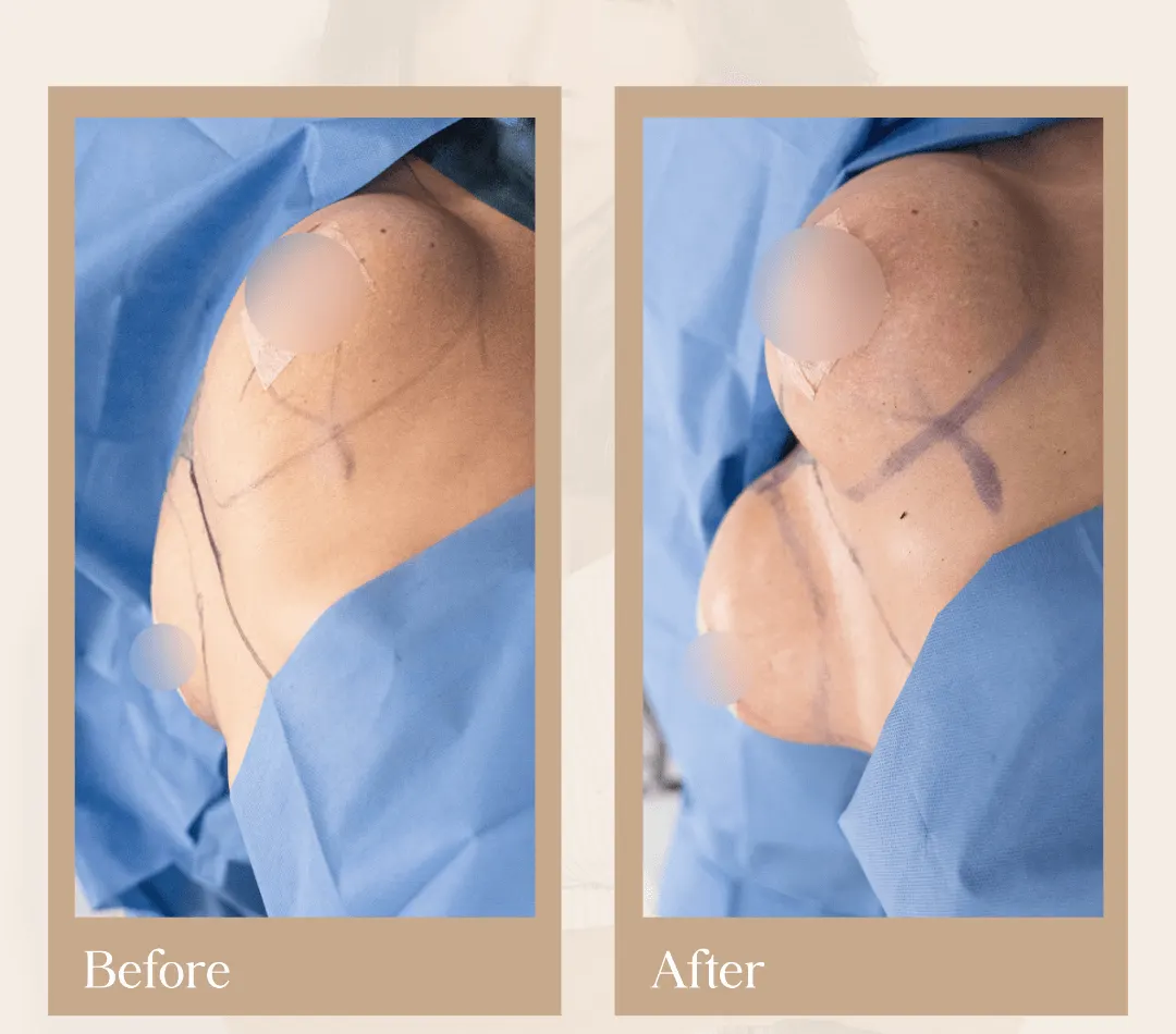 Body contouring operative result, patient 21 - Allure RT MX