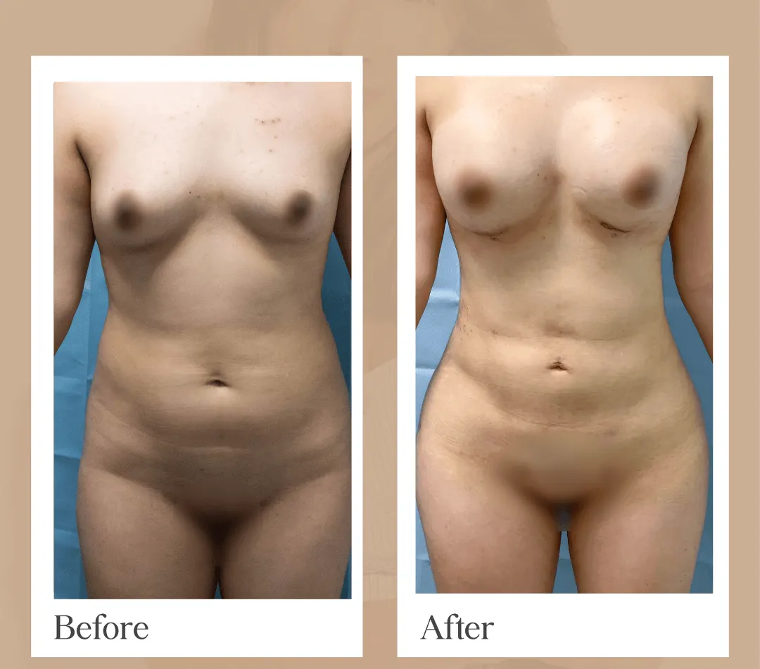 Liposuction operative result, patient 3 - Allure RT MX