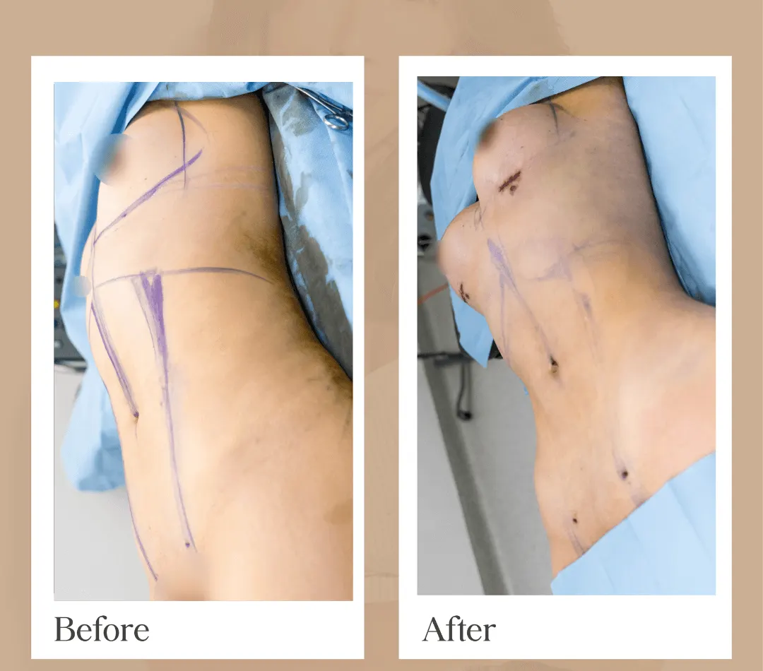Body contouring operative result, patient 4 - Allure RT MX