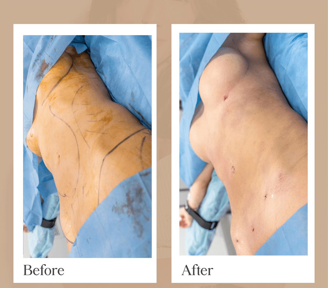 Brazilian Butt Lift operative result, patient 5 - Allure RT MX