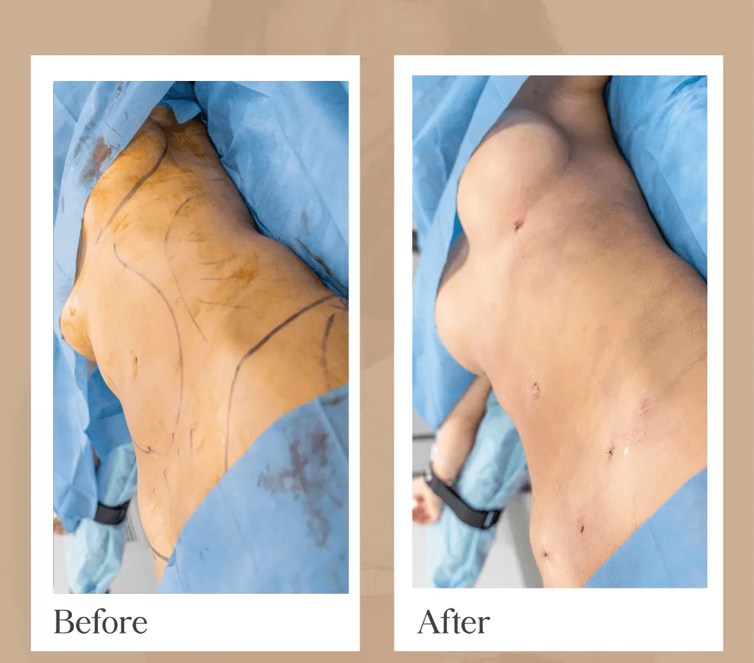 Brazilian Butt Lift operative result, patient 5 - Allure RT MX