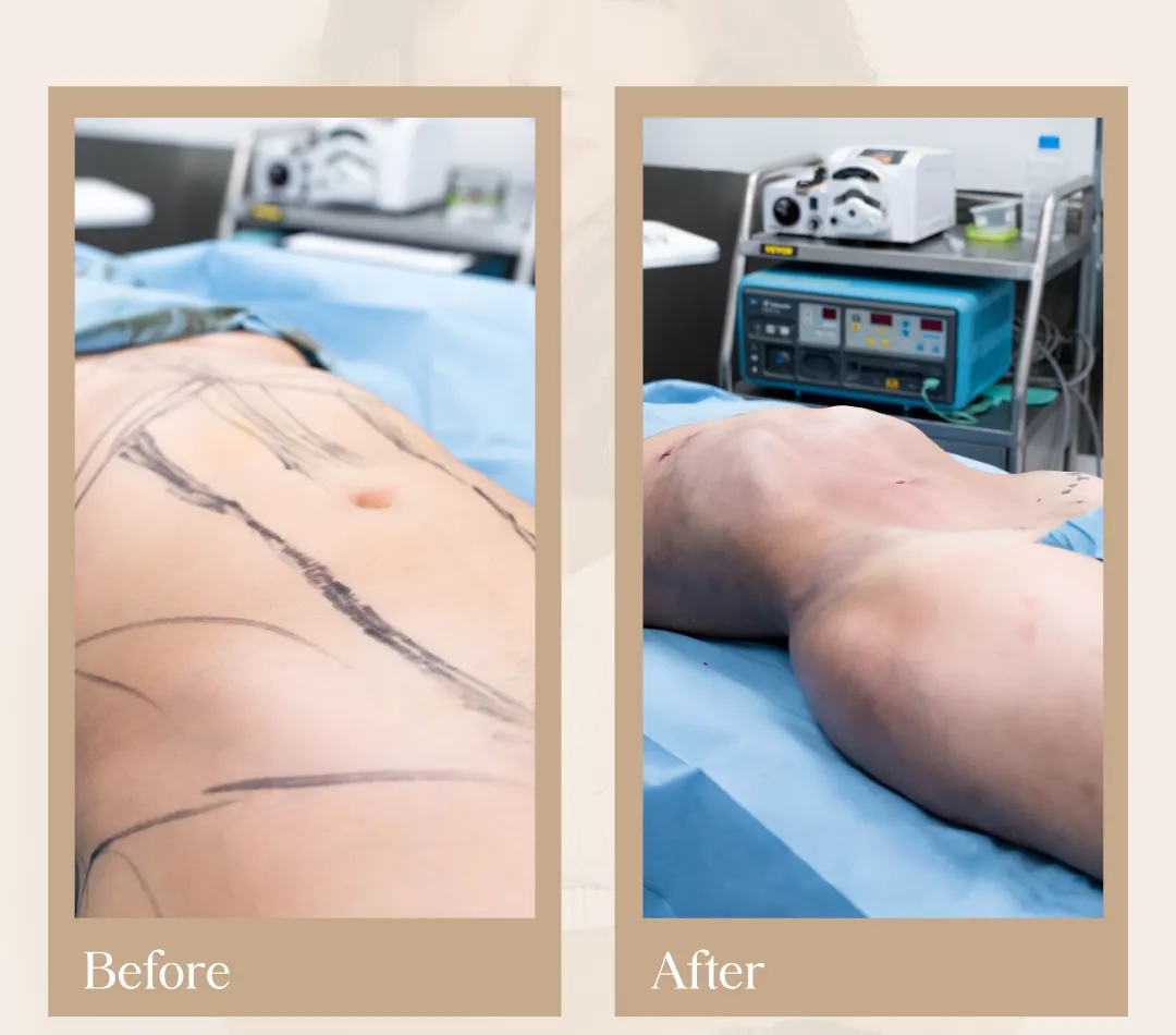 Body contouring operative result, patient 6 - Allure RT MX