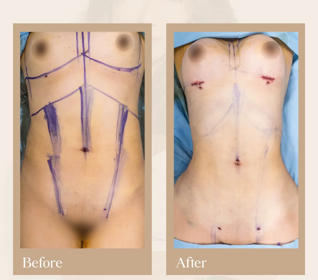 Body contouring operative result, patient 8 - Allure RT MX