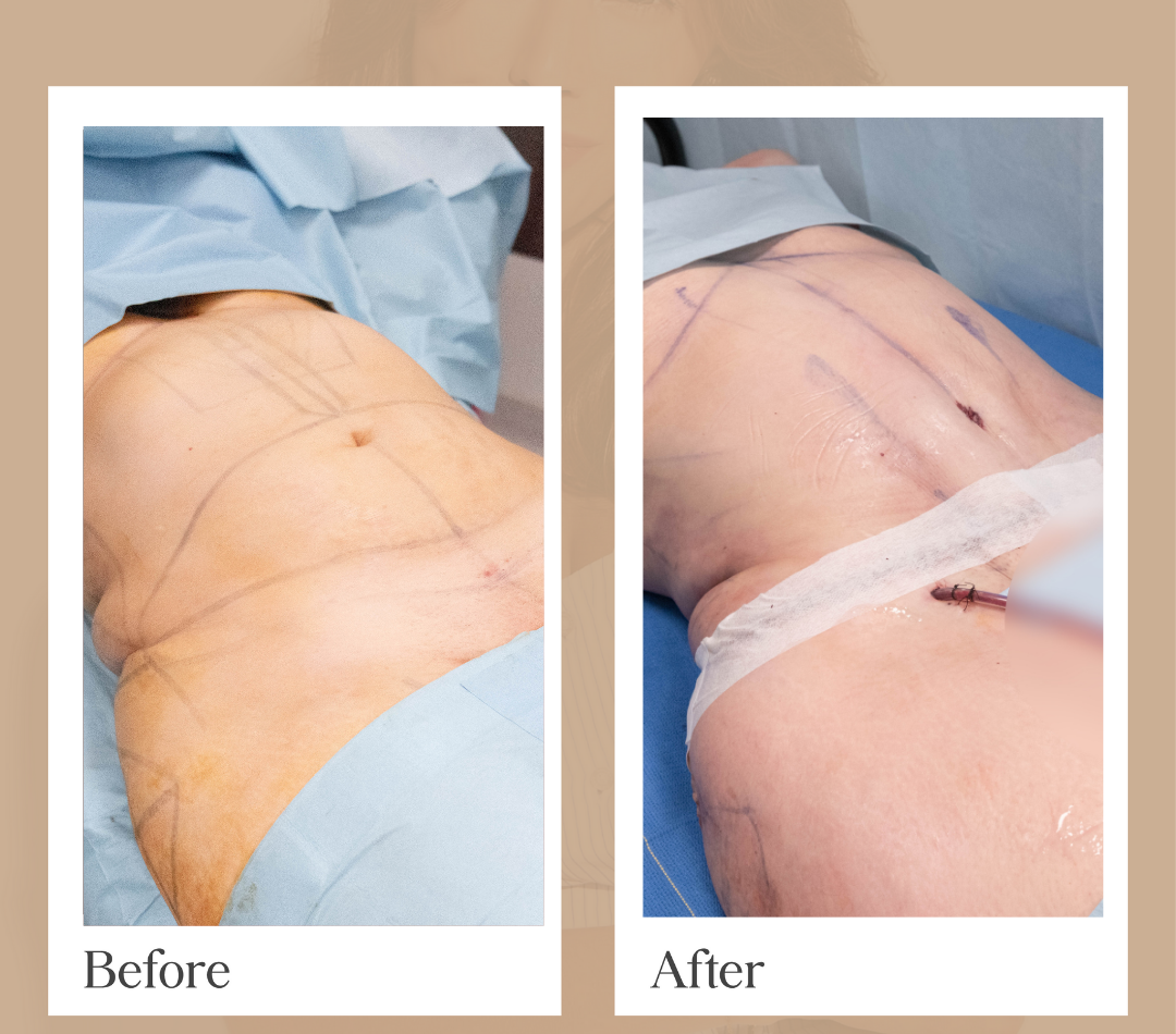 Mommy Makeover operative result, patient 9 - Allure RT MX