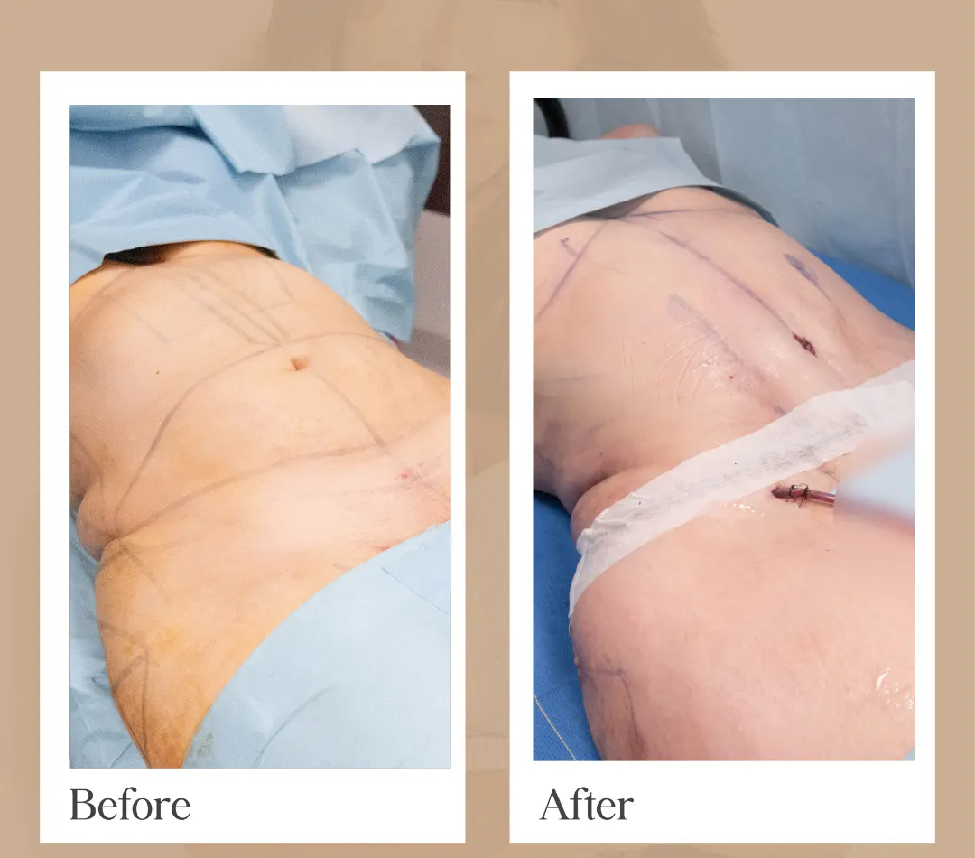 Mommy Makeover operative result, patient 9 - Allure RT MX