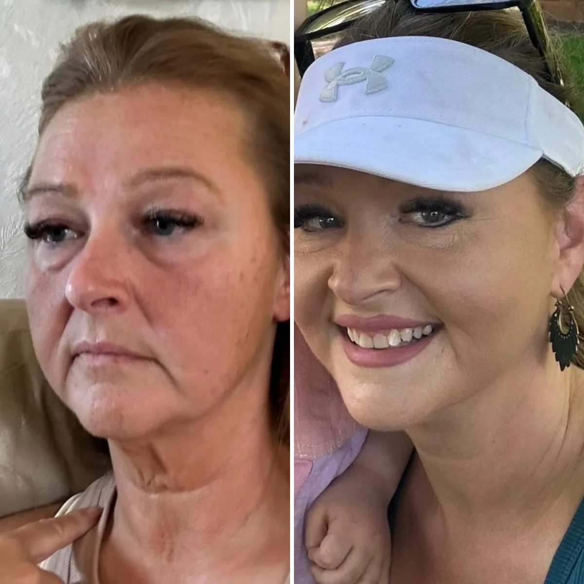 Facelift before and after: smoother jowls and neck, patient smiling after recovery