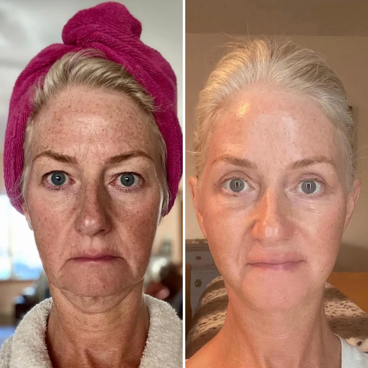 Facelift before and after, front view: lifted cheeks and smoother jawline