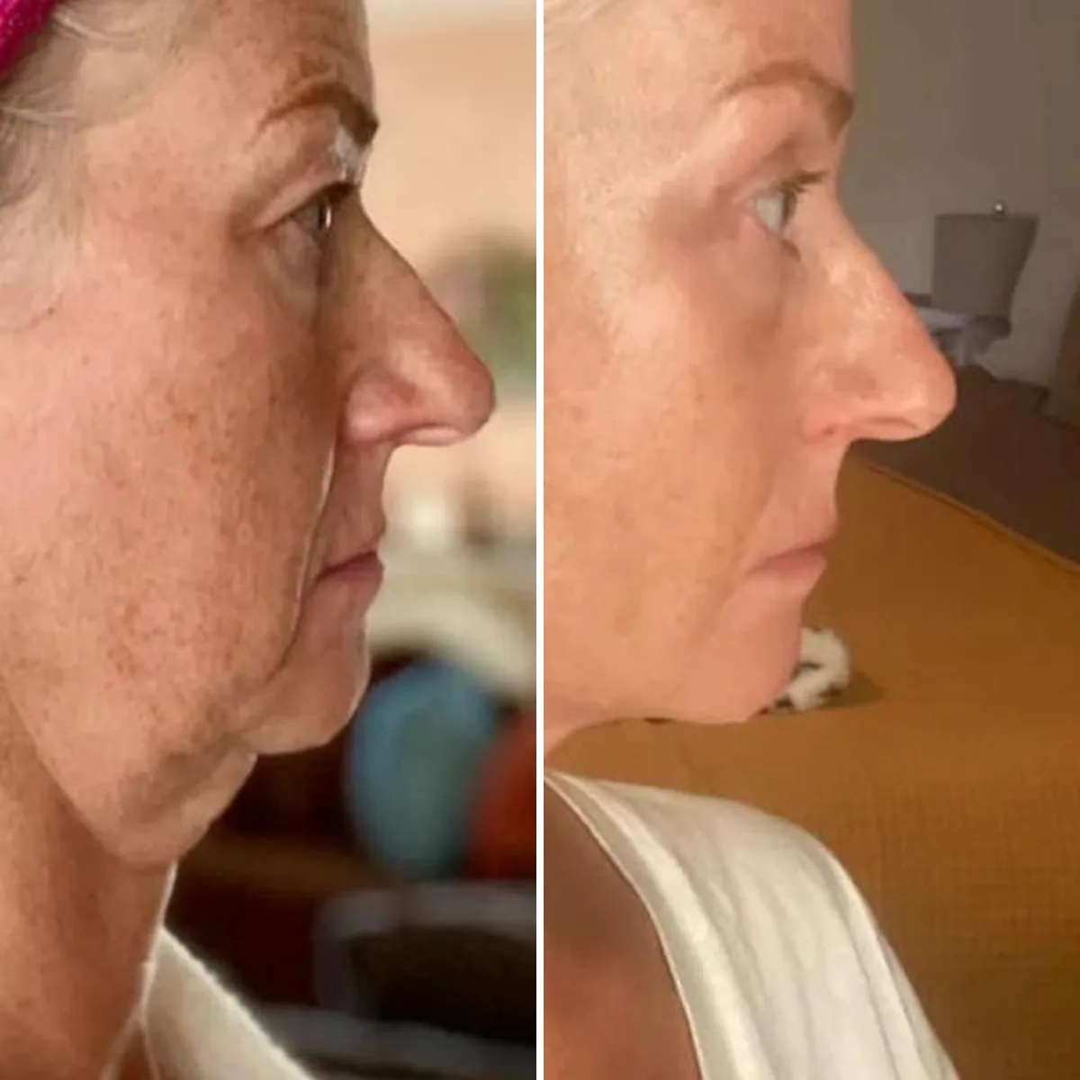 Facelift and neck before and after, right profile: a defined jawline and smoother neck