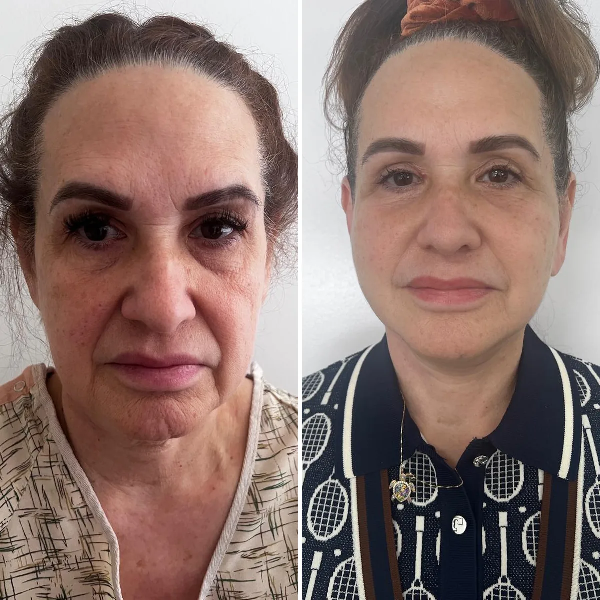 Facelift before and after, front view: softer jowls and a firmer jawline