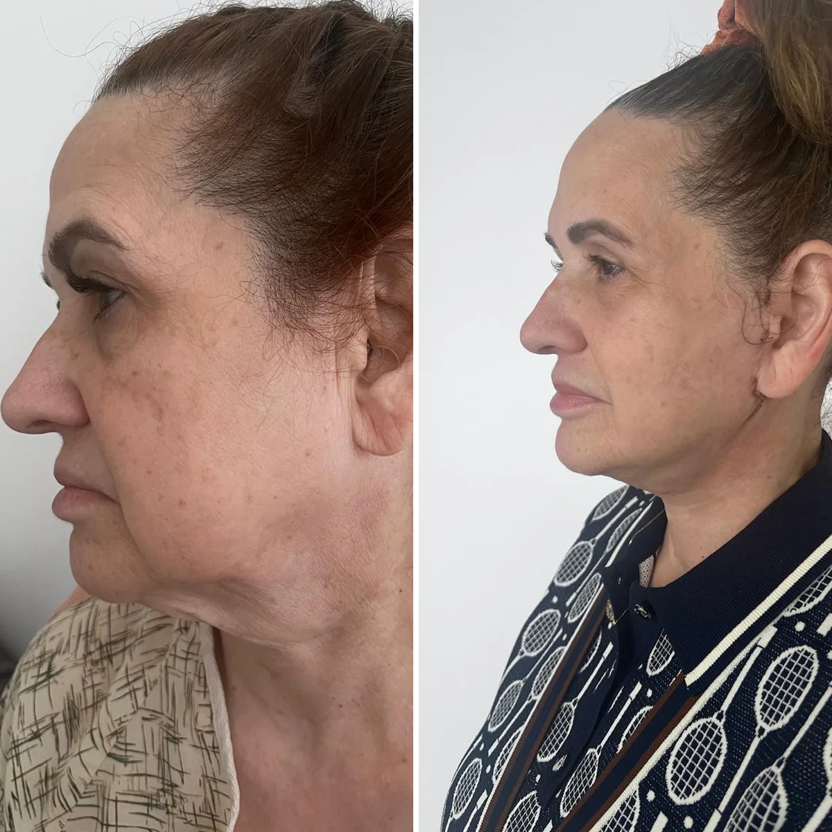 Facelift before and after, left profile: a sharper jaw and neck angle