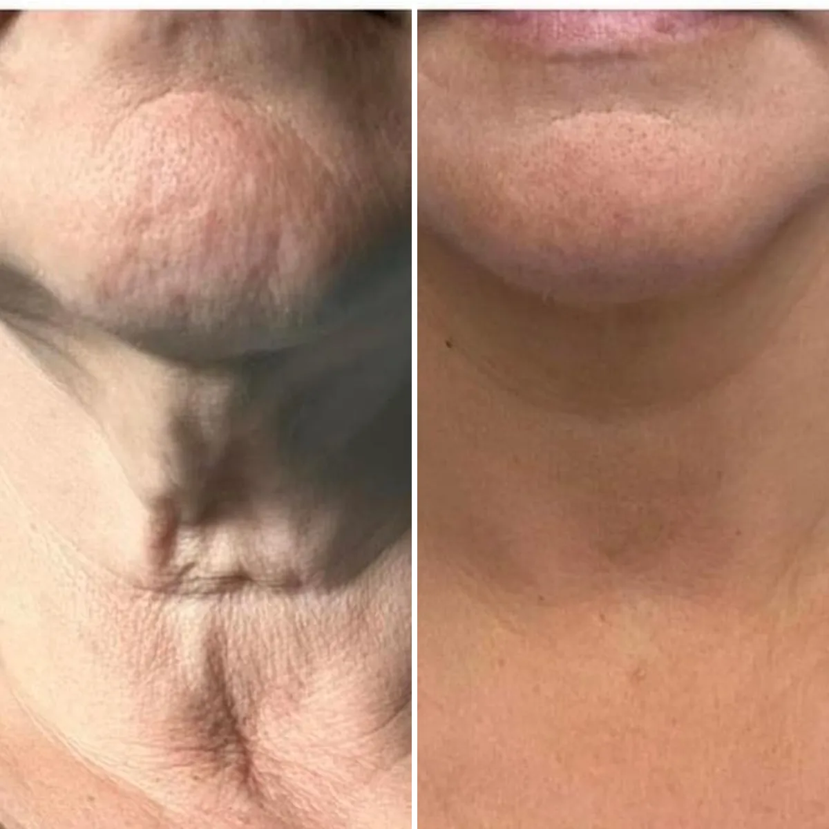 Neck lift before and after close-up: loose neck skin and bands tightened