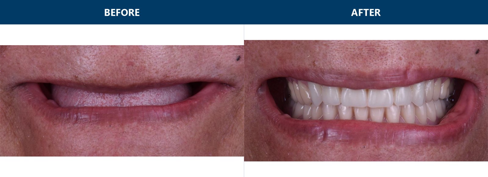 Full-mouth restoration before-and-after, edentulous arch restored with full-arch implants and final dentures