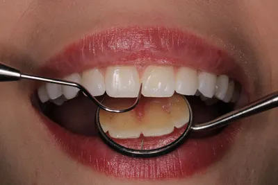 Magnified close-up of a dental mirror and pick examining the surface of upper teeth