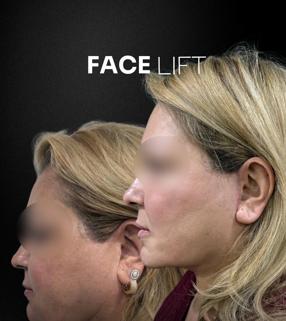 Facelift before-and-after, patient case 1