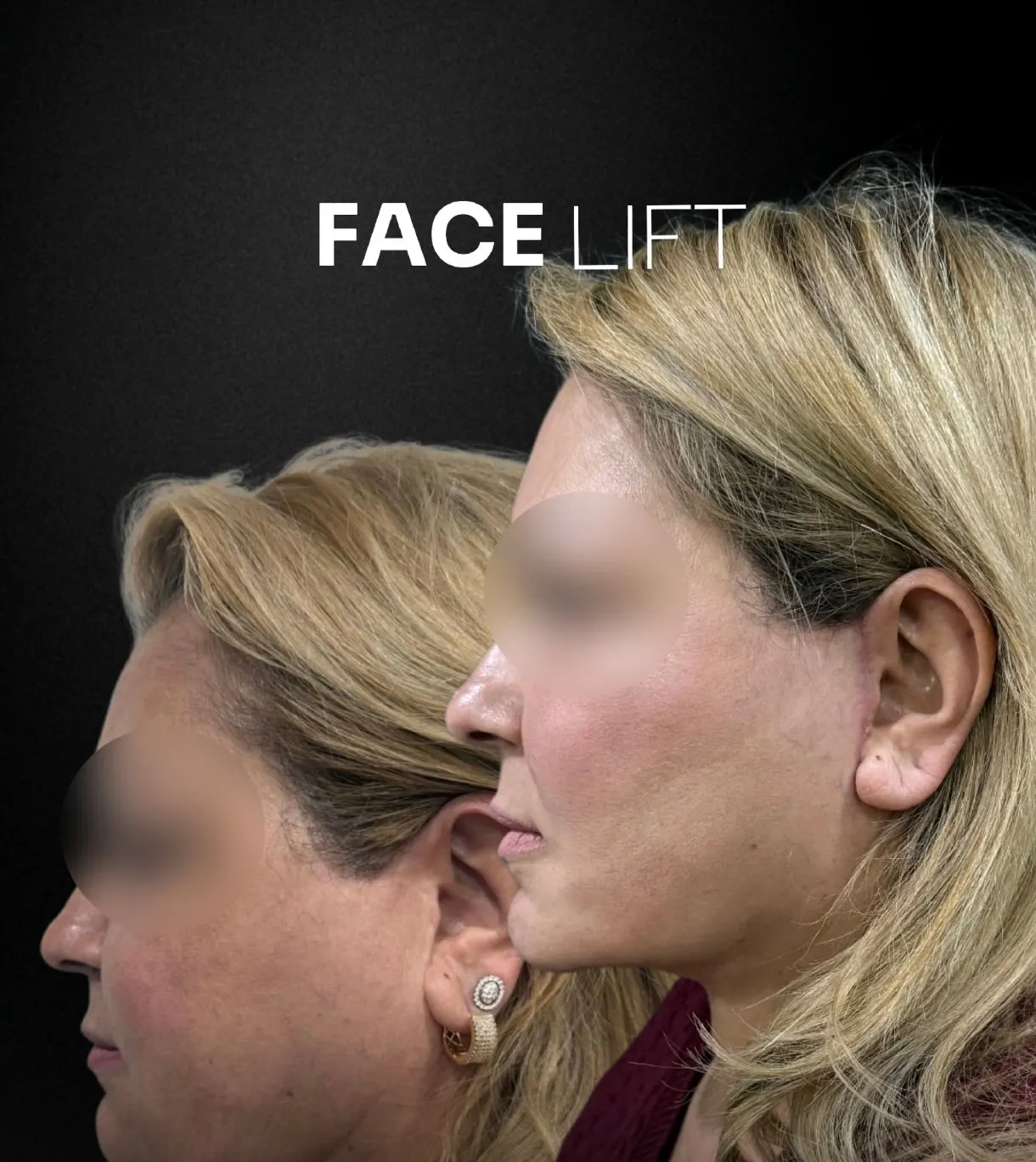 Facelift before and after, patient 1 - Allure RT MX