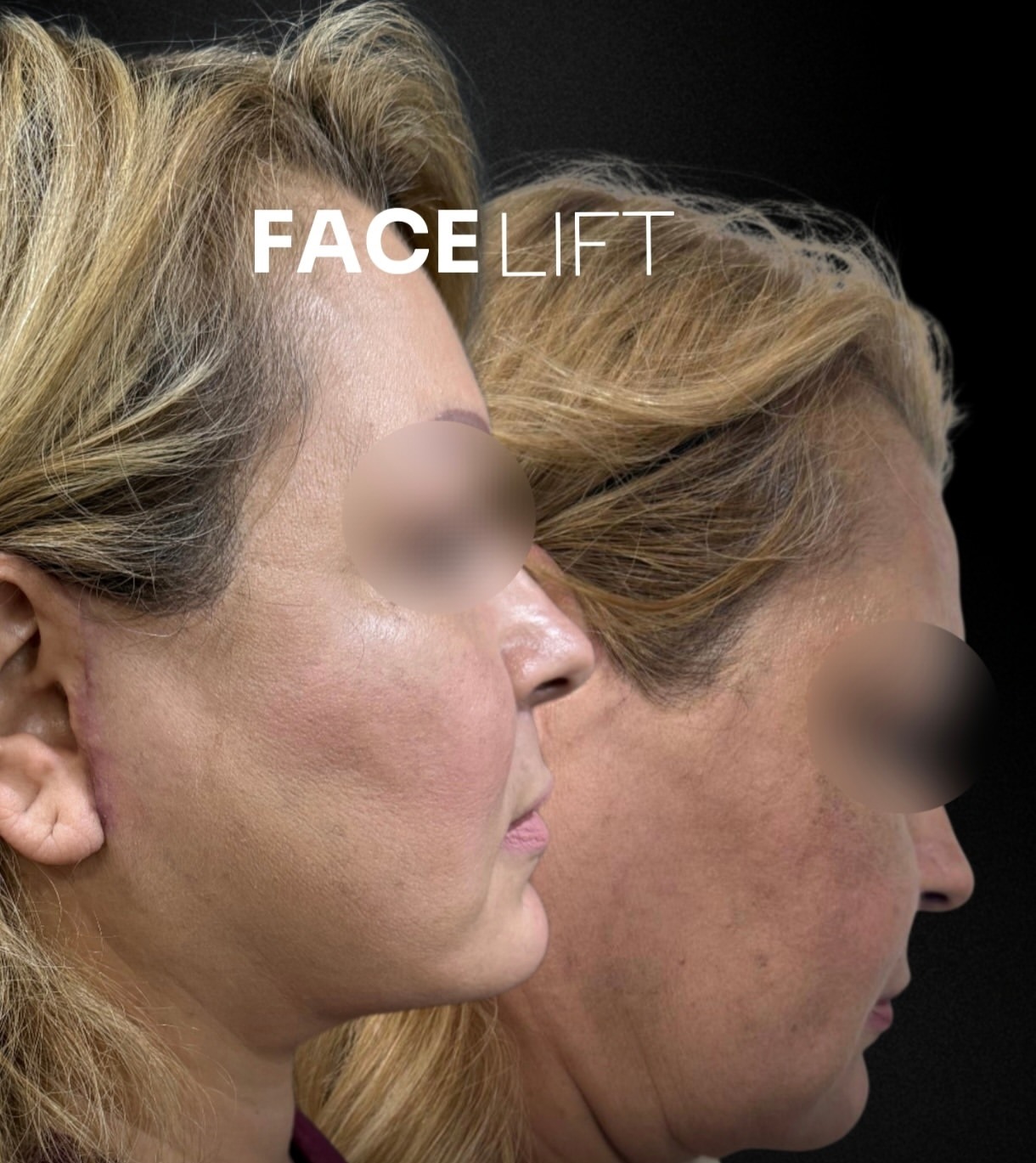 Facelift before-and-after, patient case 2