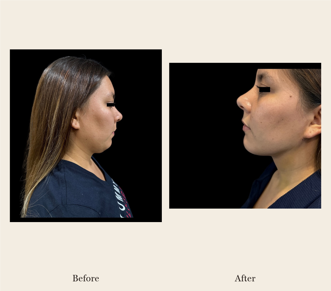 Facelift side-profile before-and-after, patient case 3