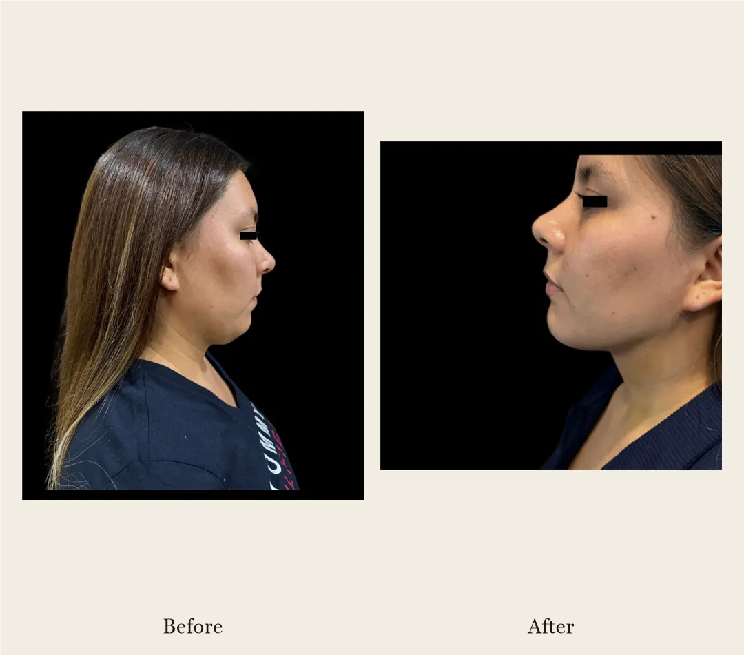 Facelift before and after, patient 3 - Allure RT MX