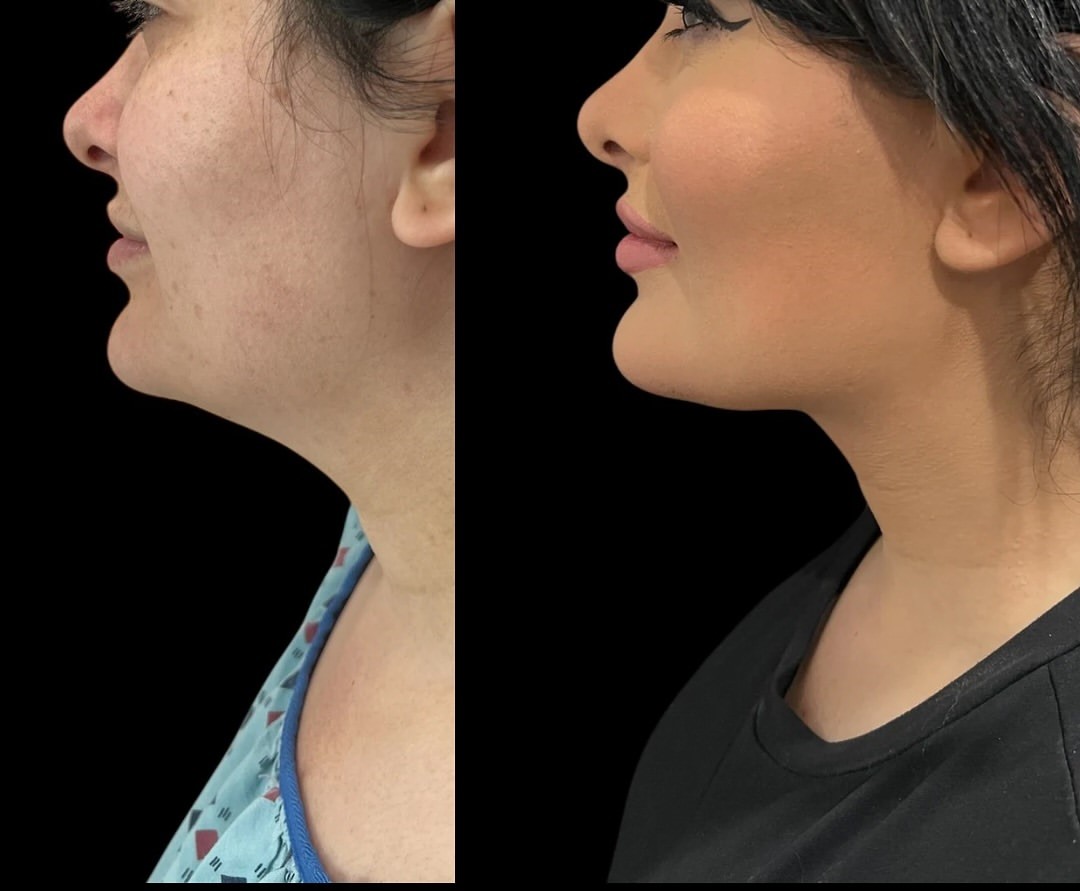 Submental liposuction before-and-after, patient case 3