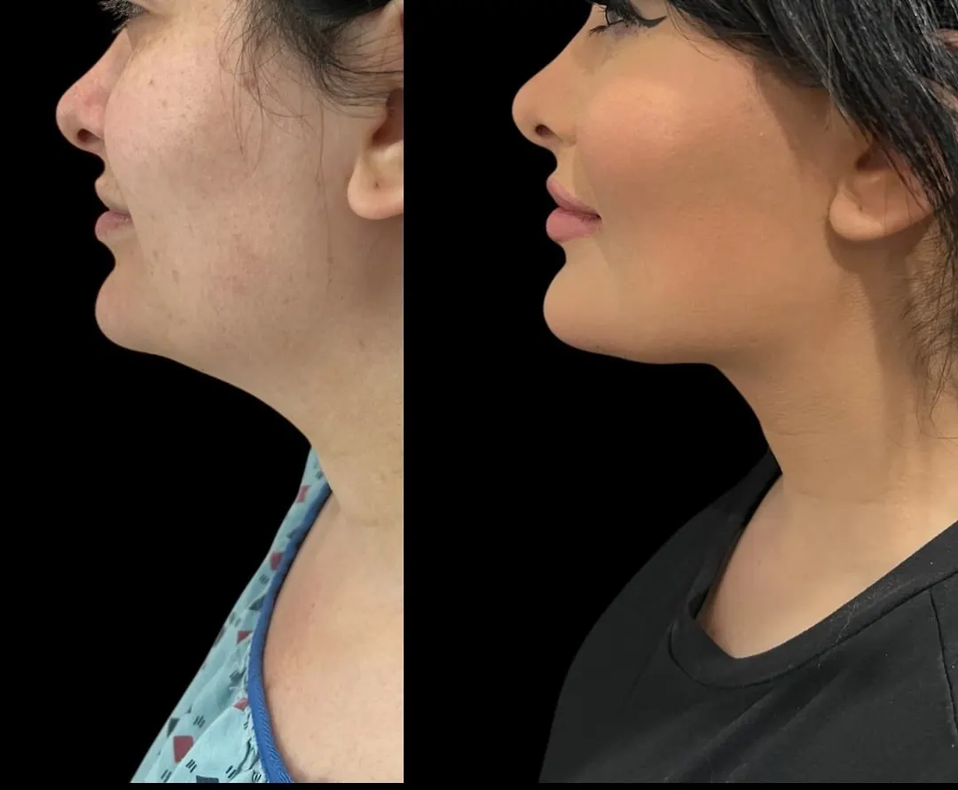 Submental liposuction before and after, patient 1 - Allure RT MX