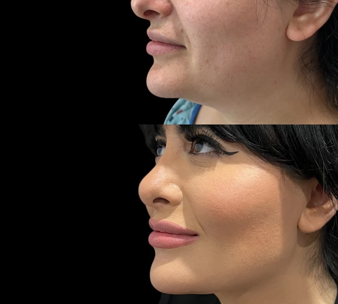 Submental liposuction before and after, patient 2 - Allure RT MX
