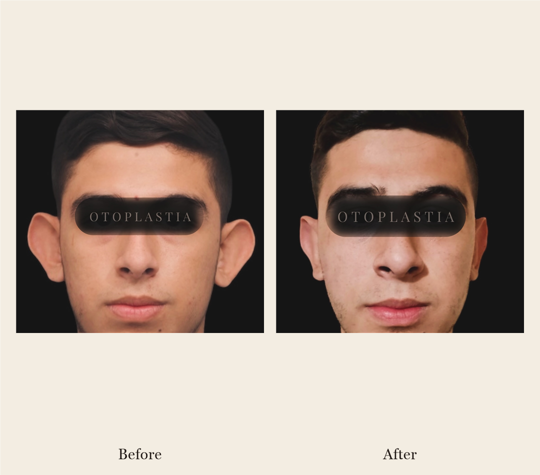 Otoplasty before-and-after, front view, patient case 1