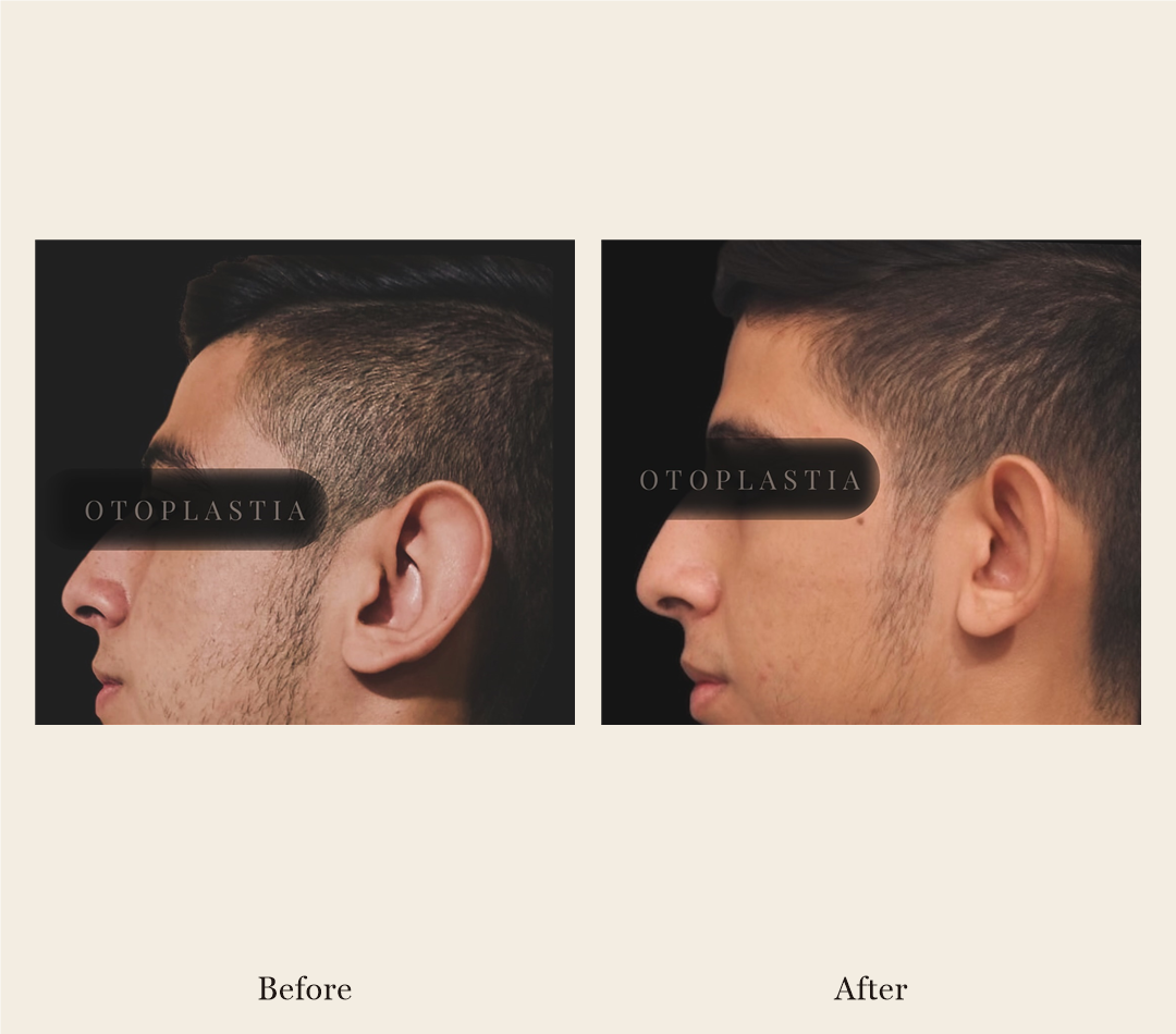 Otoplasty before and after, patient 2 - Allure RT MX