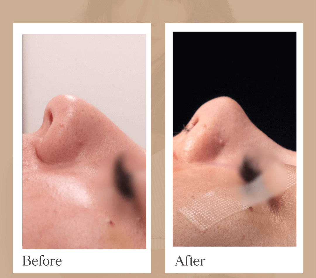 A real partner clinic rhinoplasty before-and-after photo.