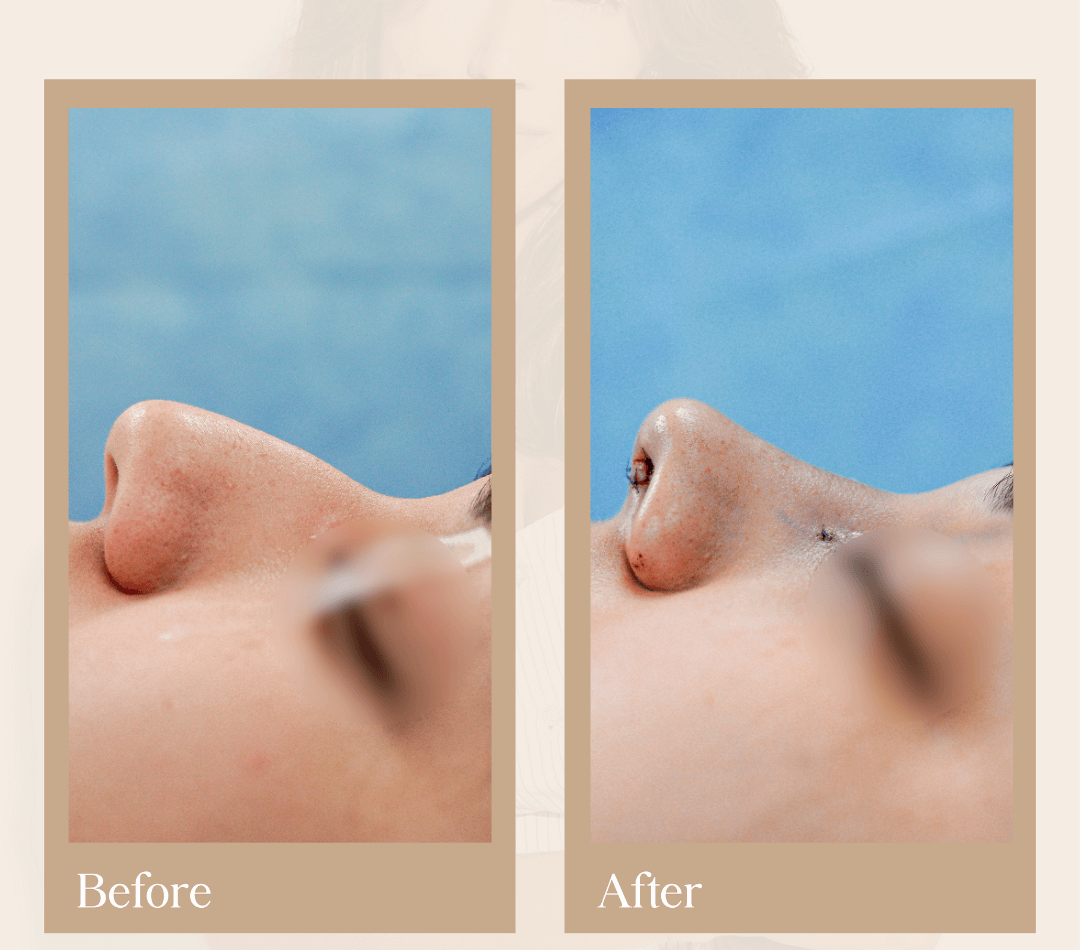 A second real partner clinic rhinoplasty before-and-after photo.