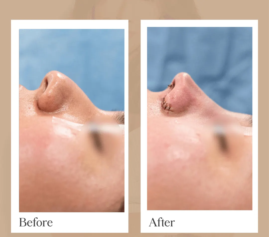 Rhinoplasty operative result, patient 3 - Allure RT MX