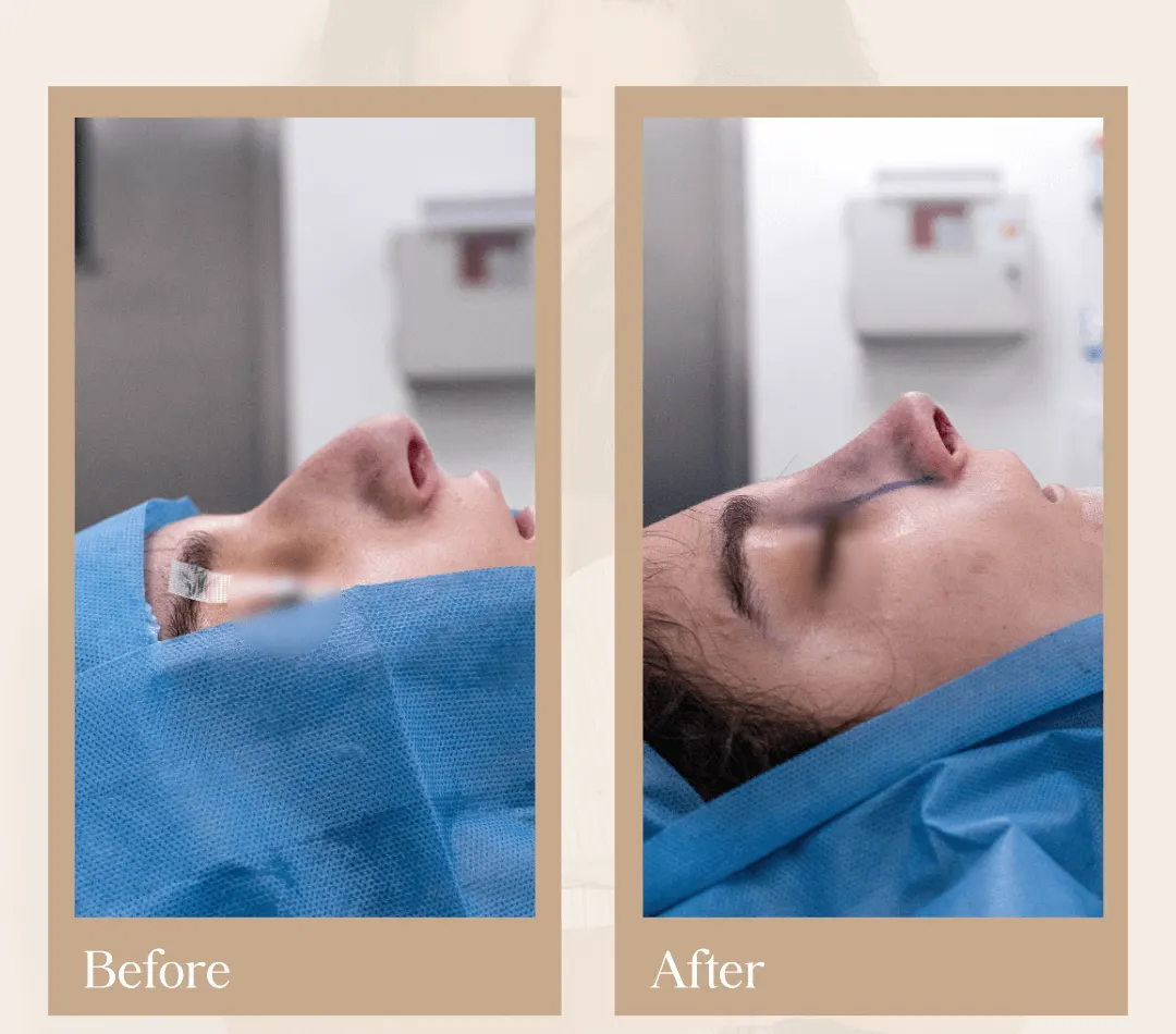 Rhinoplasty operative result, patient 4 - Allure RT MX