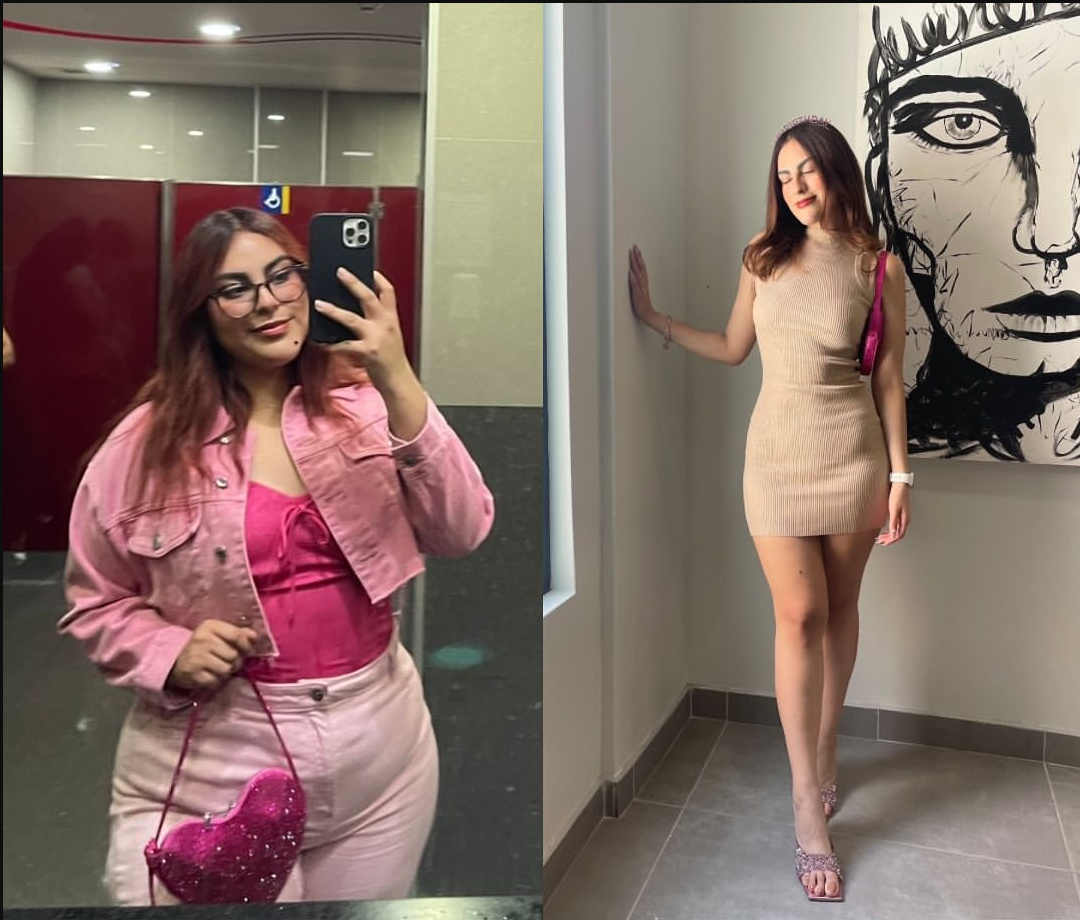 Gastric sleeve before-and-after, patient case 1
