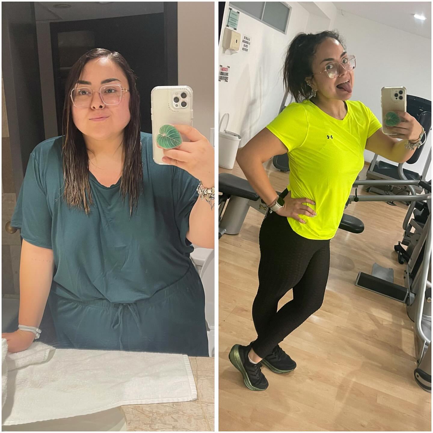 Gastric sleeve before-and-after, patient case 2