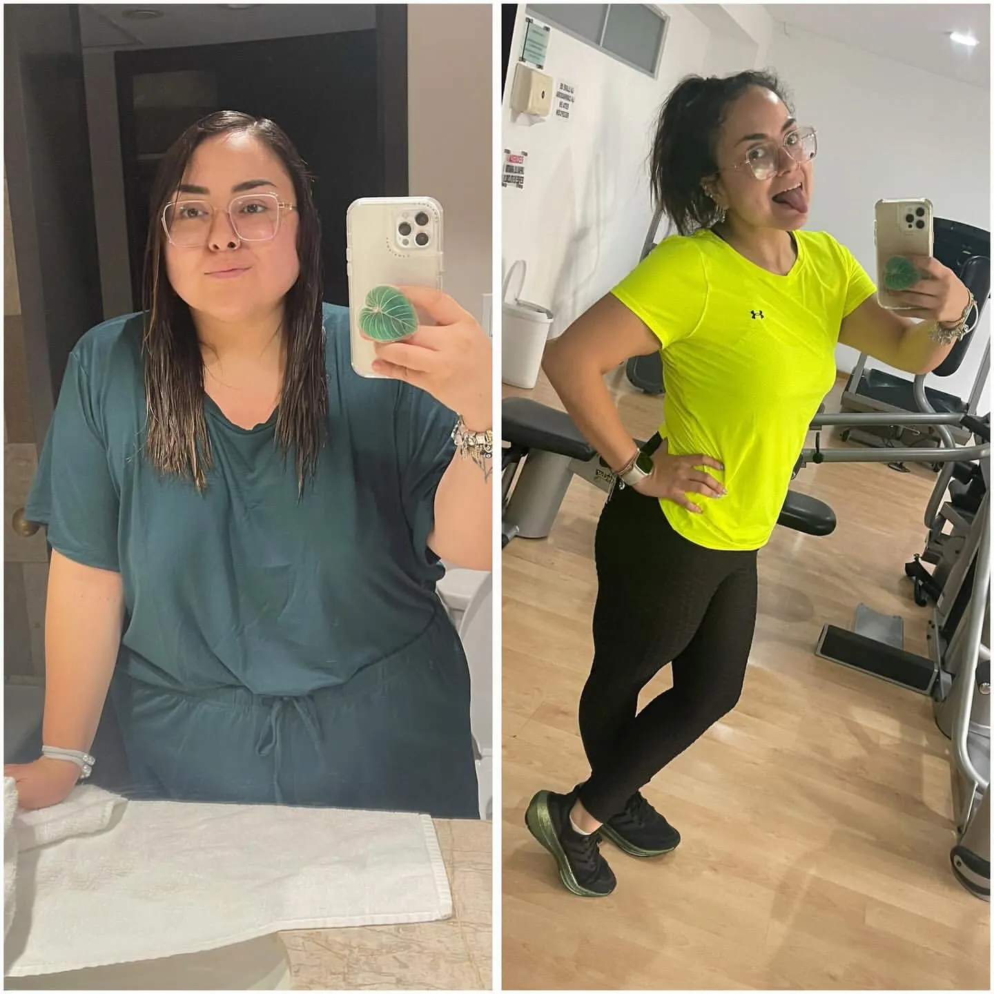 Gastric sleeve before and after, patient 2 - Allure RT MX