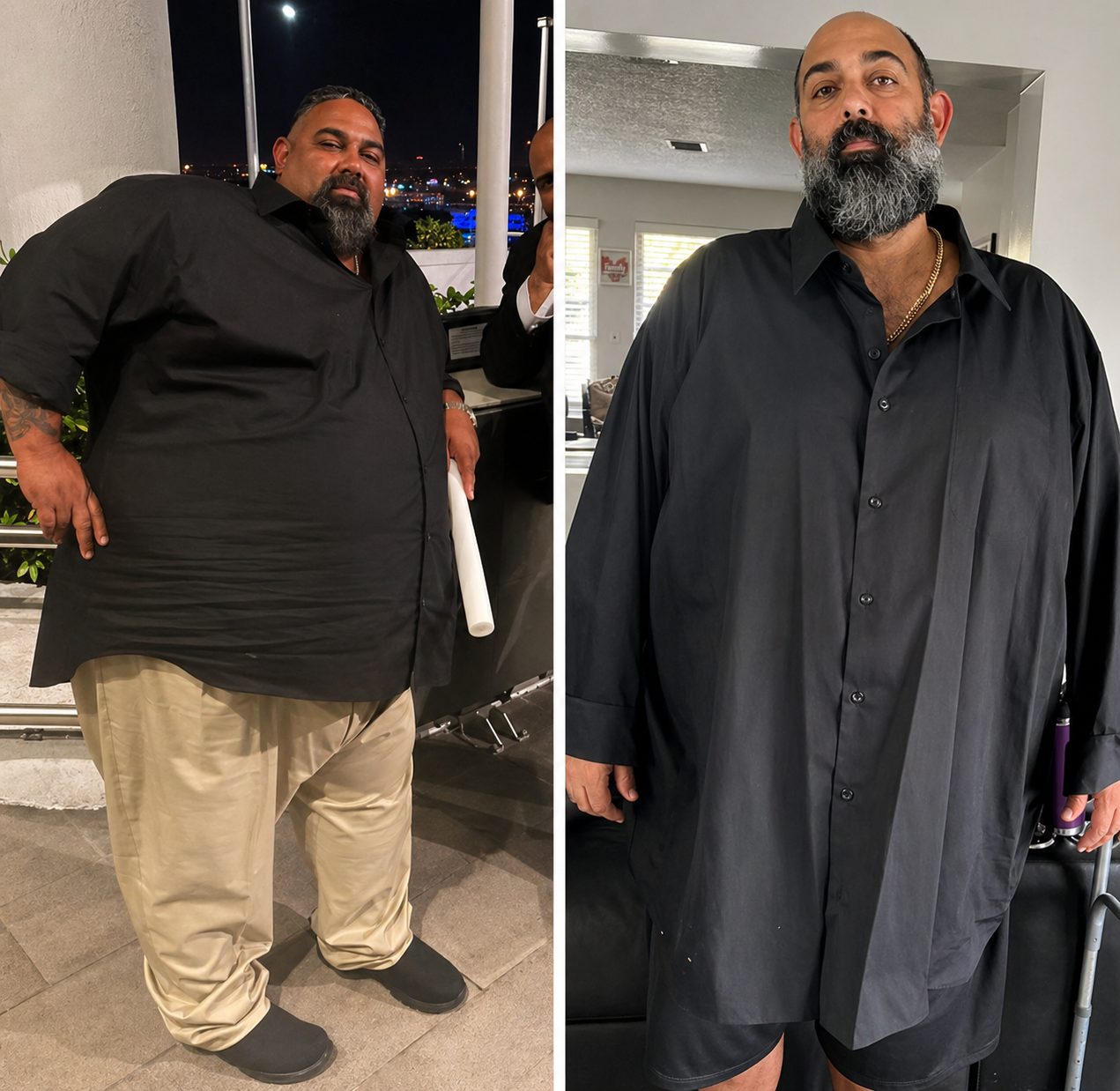 Gastric sleeve before and after, patient 3 - Allure RT MX