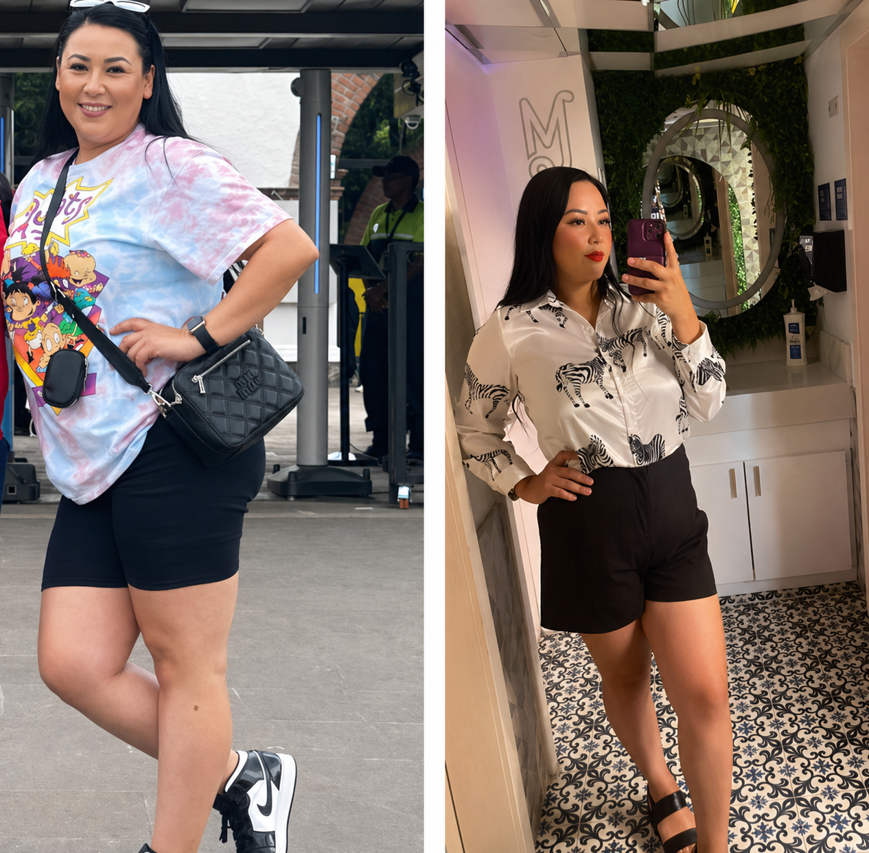 Gastric sleeve before and after, patient 5 - Allure RT MX