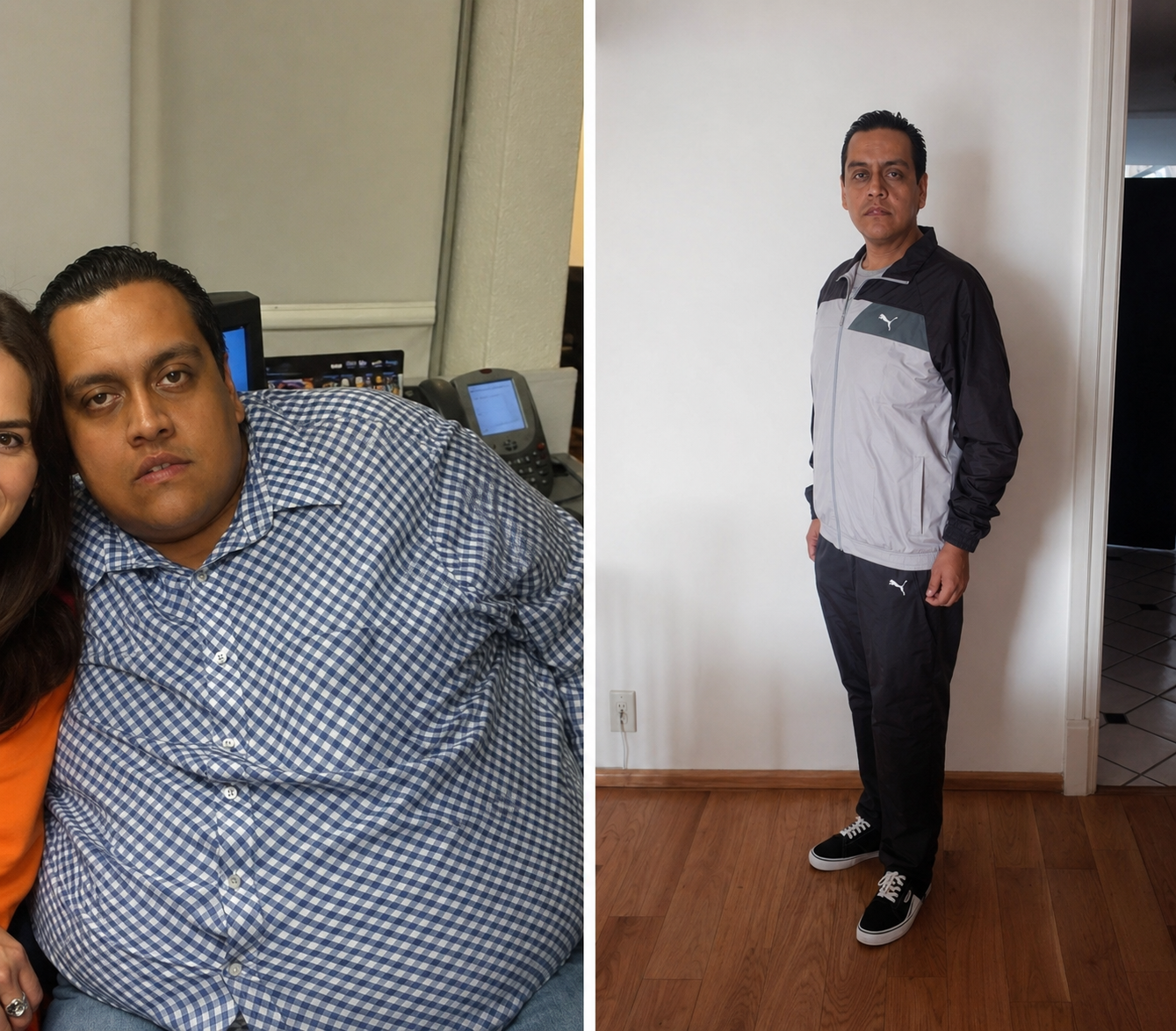 Gastric sleeve before and after, patient 9 - Allure RT MX