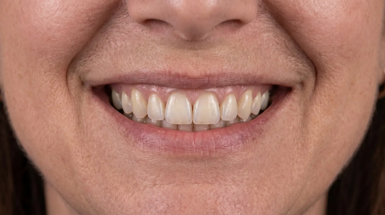 An anatomical illustration of an All-on-4 full-arch implant case.